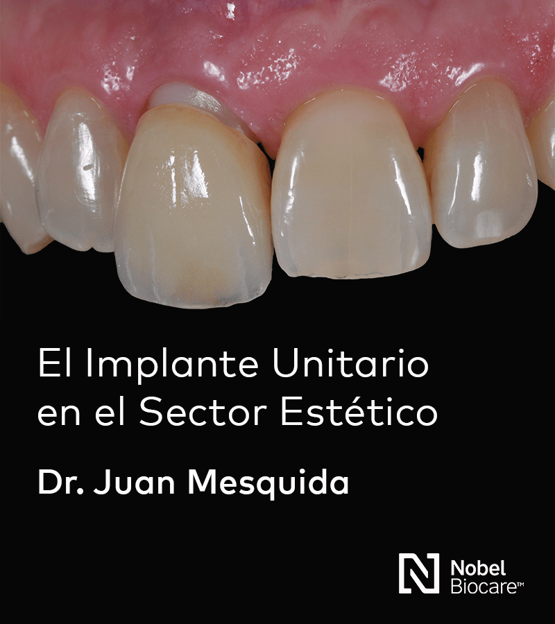 El Implante Unitario en el Sector Estético